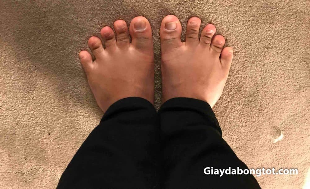 Hãy nhìn bàn chân này để hiểu về bàn chân thế nào gọi là bàn chân bè