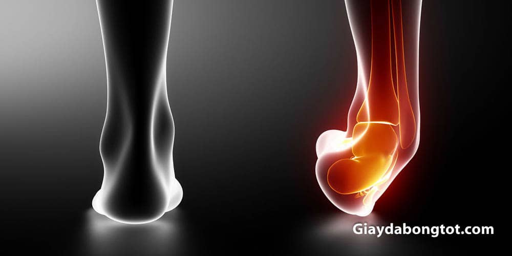 Lật cổ chân là chấn thương phổ biến thường gặp khi sử dụng giày bóng đá không ôm chân