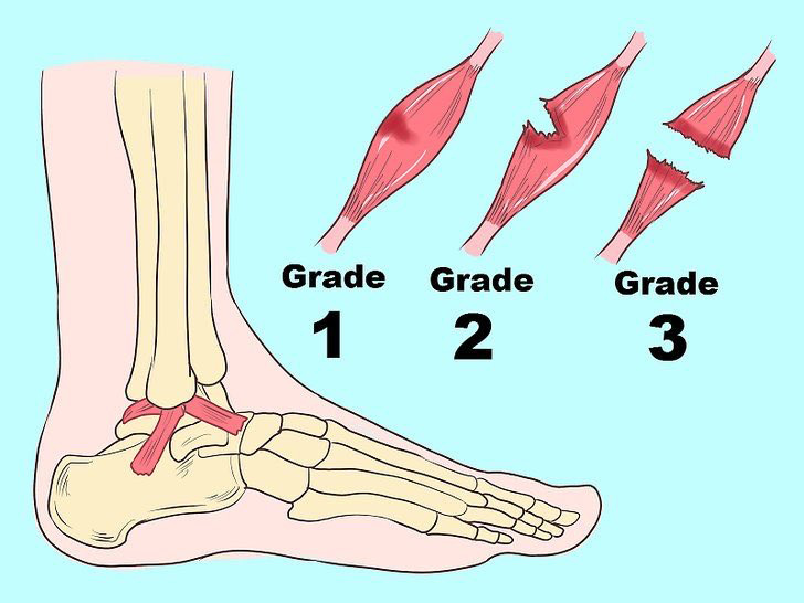 3 mức độ tổn thương khi bị lật sơ mi cổ chân